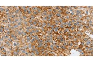 Immunohistochemistry of paraffin-embedded Human breast cancer tissue using SPARCL1 Polyclonal Antibody at dilution 1:30 (SPARCL1 抗体)