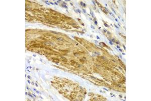 Immunohistochemistry of paraffin-embedded human gastric cancer using CDK6 antibody. (CDK6 抗体)