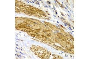 Immunohistochemistry of paraffin-embedded human gastric cancer using CDK6 antibody.