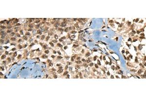 Immunohistochemistry of paraffin-embedded Human ovarian cancer tissue using CCDC12 Polyclonal Antibody at dilution of 1:60(x200) (CCDC12 抗体)