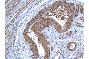 Formalin-fixed and paraffin embedded human cervical tissue labeled with Anti-AIF Polyclonal Antibody, Unconjugated (ABIN724010), followed by conjugation to the secondary antibody and DAB staining