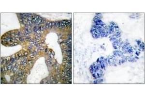 Immunohistochemistry analysis of paraffin-embedded human colon carcinoma tissue, using HSP105 Antibody. (HSPH1 抗体  (AA 791-840))