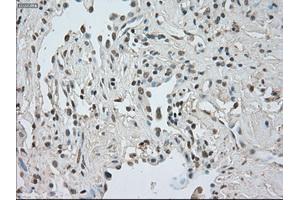 Immunohistochemical staining of paraffin-embedded Adenocarcinoma of breast tissue using anti-CTAG1B mouse monoclonal antibody. (CTAG1B 抗体)