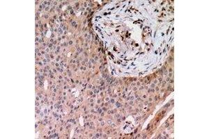 Immunohistochemical analysis of RAB24 staining in human breast cancer formalin fixed paraffin embedded tissue section. (RAB24 抗体)