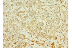 Immunohistochemistry of paraffin-embedded human pancreatic cancer using ABIN7164617 at dilution of 1:100 (TTLL2 抗体  (AA 401-592))