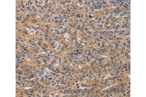 Immunohistochemistry of Human lung cancer using NCR2 Polyclonal Antibody at dilution of 1:60 (NKp44/NCR2 抗体)