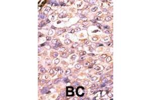 Formalin-fixed and paraffin-embedded human cancer tissue reacted with the primary antibody, which was peroxidase-conjugated to the secondary antibody, followed by AEC staining. (DUSP7 抗体  (N-Term))