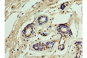 Immunohistochemistry of paraffin-embedded human breast cancer using ABIN7156290 at dilution of 1:100 (IMPDH2 抗体  (AA 215-514))