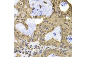 Immunohistochemistry of paraffin-embedded human oophoroma using TERF2IP antibody at dilution of 1:100 (40x lens). (RAP1 抗体)