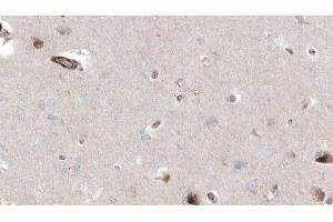 ABIN6272940 at 1/100 staining Human brain cancer tissue by IHC-P.
