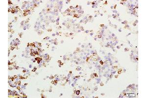 Formalin-fixed and paraffin embedded rat lung melanoma labeled with Anti-MAGE-1 Polyclonal Antibody, Unconjugated  at 1:200, followed by conjugation to the secondary antibody and DAB staining (MAGEA1 抗体  (AA 101-200))