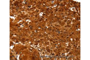 Immunohistochemistry of Human esophagus cancer using NCOR1 Polyclonal Antibody at dilution of 1:60 (NCOR1 抗体)