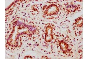 IHC image of ABIN7148842 diluted at 1:400 and staining in paraffin-embedded human breast cancer performed on a Leica BondTM system.