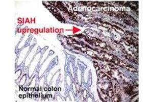 Immunohistochemical staining of SIAH2 on human colorectal adenocarcinoma with SIAH2 monoclonal antibody, clone 24E6H3 . (SIAH2 抗体  (AA 1-100))