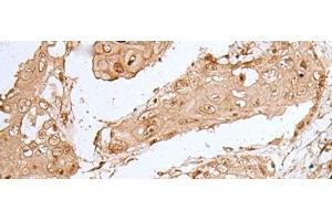 Immunohistochemistry of paraffin-embedded Human esophagus cancer tissue using HOXC9 Polyclonal Antibody at dilution of 1:35(x200) (HOXC9 抗体)