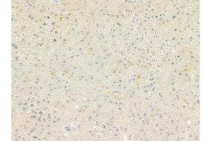 ABIN6260737 and ABIN6279257 at 1/100 staining human hepatocellular carcinoma by IHC-P. (CEACAM16 抗体  (Internal Region))