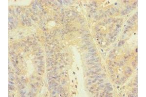 Immunohistochemistry of paraffin-embedded human colon cancer using ABIN7172830 at dilution of 1:100 (TGFB3 抗体  (AA 24-300))
