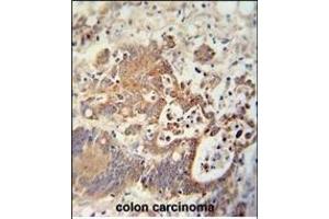 CHCHD2 antibody (Center) (ABIN654013 and ABIN2843939) immunohistochemistry analysis in formalin fixed and paraffin embedded human colon carcinoma followed by peroxidase conjugation of the secondary antibody and DAB staining. (CHCHD2 抗体  (AA 74-103))