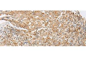 Immunohistochemistry of paraffin-embedded Human cervical cancer tissue using MBOAT4 Polyclonal Antibody at dilution of 1:30(x200) (MBOAT4 抗体)