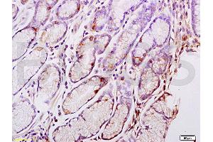 Formalin-fixed and paraffin embedded human gastric carcinoma tissue labeled with Anti-CENPA Polyclonal Antibody, Unconjugated (ABIN750113) at 1:200 followed by conjugation to the secondary antibody and DAB staining (CENPA 抗体  (AA 65-140))
