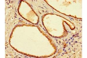 Immunohistochemistry of paraffin-embedded human prostate cancer using ABIN7166350 at dilution of 1:100 (YIPF6 抗体  (AA 2-84))