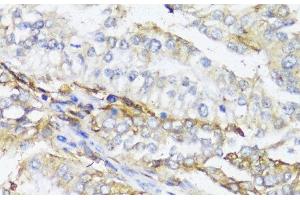 Immunohistochemistry of paraffin-embedded Human colon carcinoma using HLA-DPB1 Polyclonal Antibody at dilution of 1:100 (40x lens). (HLA-DPB1 抗体)