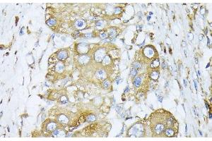 Immunohistochemistry of paraffin-embedded Human liver cancer using CALR Polyclonal Antibody at dilution of 1:100 (40x lens). (Calreticulin 抗体)