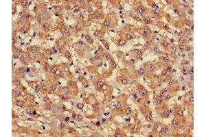 Immunohistochemistry of paraffin-embedded human liver cancer using ABIN7153167 at dilution of 1:100 (FFAR3 抗体  (AA 280-346))