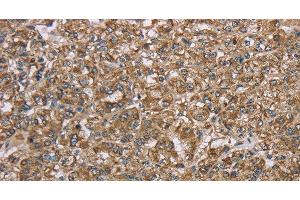 Immunohistochemistry of paraffin-embedded Human prostate cancer using CERS4 Polyclonal Antibody at dilution of 1:35 (LASS4 抗体)