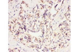 IHC-P: VEGF antibody testing of human lung cancer tissue (VEGFA 抗体  (AA 27-191))