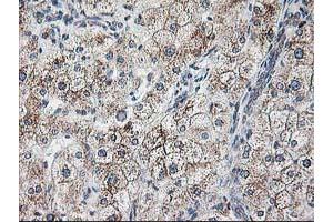 Immunohistochemical staining of paraffin-embedded Human liver tissue using anti-RPN1 mouse monoclonal antibody. (RPN1 抗体)