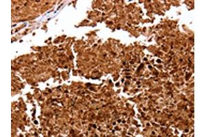 The image on the left is immunohistochemistry of paraffin-embedded Human lung cancer tissue using ABIN7128966(CLEC4A Antibody) at dilution 1/15, on the right is treated with fusion protein. (CLEC4A 抗体)