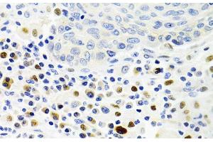 Immunohistochemistry of paraffin-embedded Human lung cancer using GEMIN2 Polyclonal Antibody at dilution of 1:100 (40x lens). (SIP1 抗体)