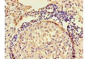 Immunohistochemistry of paraffin-embedded human lung cancer using ABIN7144308 at dilution of 1:100 (Anoctamin 4 抗体  (AA 1-200))