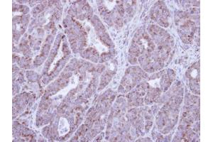 IHC-P Image Immunohistochemical analysis of paraffin-embedded NCIN87 Xenograft , using HAX1, antibody at 1:100 dilution. (HAX1 抗体)