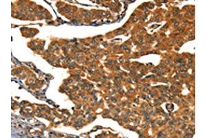 The image on the left is immunohistochemistry of paraffin-embedded Human breast cancer tissue using ABIN7190038(CACNA1E Antibody) at dilution 1/15, on the right is treated with synthetic peptide. (CACNA1E 抗体)