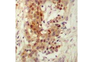 Immunohistochemical analysis of PKC iota/zeta staining in human breast cancer formalin fixed paraffin embedded tissue section. (PKC iota/zeta 抗体)