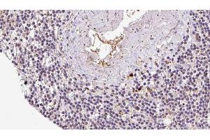 ABIN6273070 at 1/100 staining Human lymph cancer tissue by IHC-P. (RCN2 抗体  (C-Term))