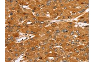 The image on the left is immunohistochemistry of paraffin-embedded Human liver cancer tissue using ABIN7130217(MED22 Antibody) at dilution 1/40, on the right is treated with fusion protein. (MED22 抗体)