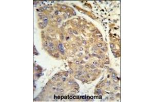 Formalin-fixed and paraffin-embedded human hepatocarcinoma reacted with PHACTR2 Antibody (N-term), which was peroxidase-conjugated to the secondary antibody, followed by DAB staining. (PHACTR2 抗体  (N-Term))