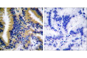 Peptide - +Immunohistochemical analysis of paraffin-embedded human breast carcinoma tissue using BIK (Ab-33) antibody (#B0053). (BIK 抗体  (Thr33))