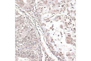 Immunohistochemistry of paraffin-embedded human endometrium cancer using MEF2C antibody (ABIN6132345, ABIN6143716, ABIN6143717 and ABIN6215998) at dilution of 1:100 (40x lens). (MEF2C 抗体  (AA 170-380))