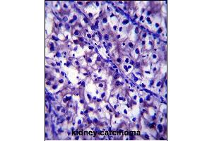LB1 Antibody (C-term) (ABIN657904 and ABIN2846855) immunohistochemistry analysis in formalin fixed and paraffin embedded human kidney carcinoma followed by peroxidase conjugation of the secondary antibody and DAB staining. (Laminin beta 1 抗体  (C-Term))