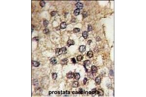 Formalin-fixed and paraffin-embedded human prostata carcinoma tissue reacted with CLOCK antibody (Center) (ABIN391842 and ABIN2841680) , which was peroxidase-conjugated to the secondary antibody, followed by DAB staining. (CLOCK 抗体  (AA 215-249))