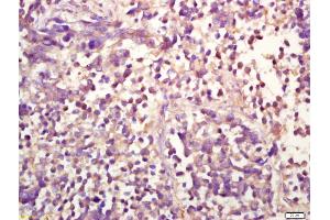 Formalin-fixed and paraffin embedded human lung carcinoma labeled with Anti-phospho-ERK1(Thr202/Tyr204) +ERK2(Thr183/Tyr185) Polyclonal Antibody, Unconjugated (ABIN732458) at 1:200 followed by conjugation to the secondary antibody and DAB staining (ERK1/2 抗体  (pThr183, pTyr185))