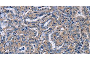 Immunohistochemistry of paraffin-embedded Human thyroid cancer tissue using NCR2 Polyclonal Antibody at dilution 1:60 (NKp44/NCR2 抗体)