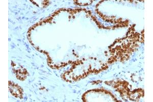 Formalin-fixed, paraffin-embedded human Prostate Carcinoma stained with FOXA1 Monoclonal Antibody (FOXA1/1241). (FOXA1 抗体  (AA 372-472))