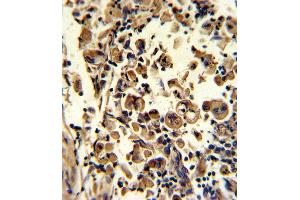 Formalin-fixed and paraffin-embedded human lung carcinoma reacted with SOD3 Antibody (N-term), which was peroxidase-conjugated to the secondary antibody, followed by DAB staining. (SOD3 抗体  (N-Term))