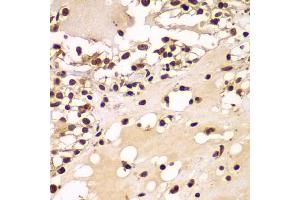 Immunohistochemistry of paraffin-embedded human kidney cancer using ZNF20 antibody (ABIN5975115) at dilution of 1/100 (40x lens). (ZNF20 抗体)