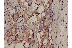 Immunohistochemistry analysis of human breast cancer using ABIN7174064 at dilution of 1:100 (SRMS 抗体  (AA 19-155))